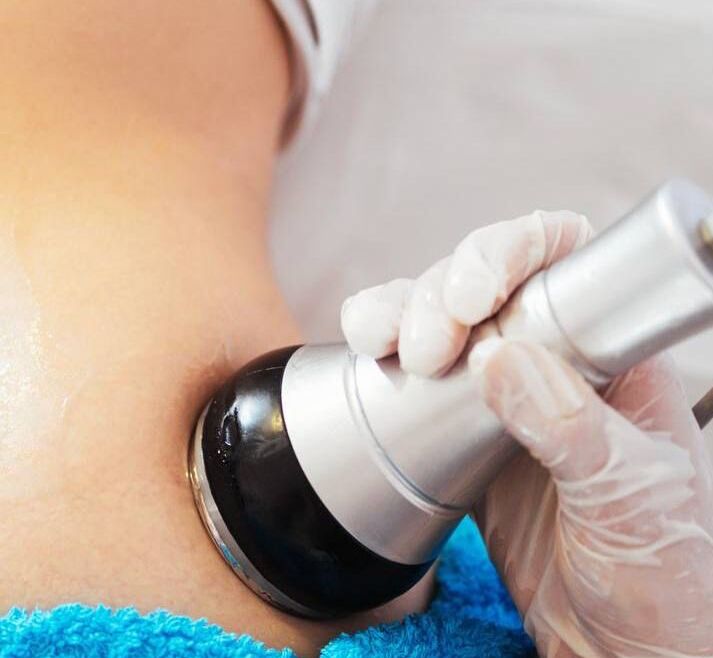 Med. zertifiziertes System gegen Cellulite und sportresistente Fettdepots. Kavitation mit Vakuum Radiofrequenz